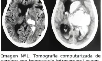 Tomografía computarizada, Hematoma Intracerebral