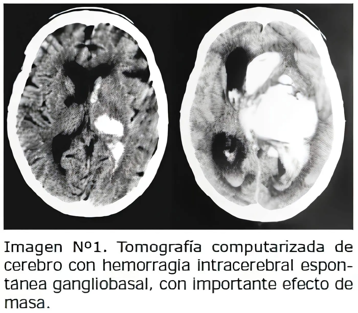  Tomografía computarizada, Hematoma Intracerebral