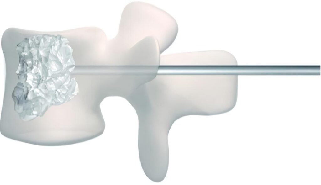 Artículos de Revisión: Aproximación Técnica e Histórica a la Vertebroplastia
