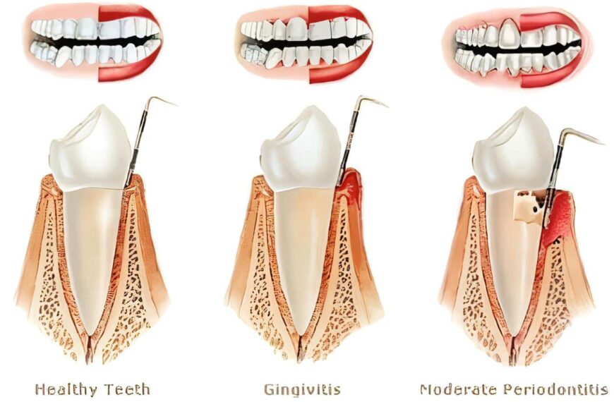 Enfermedad Periodontal