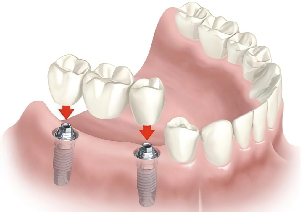 Colocación de Implantes