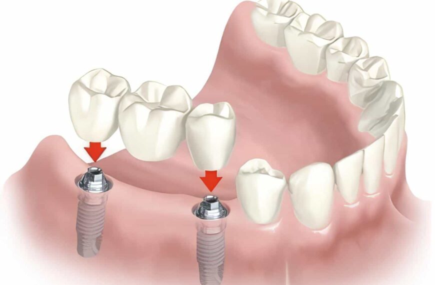 Colocación de Implantes