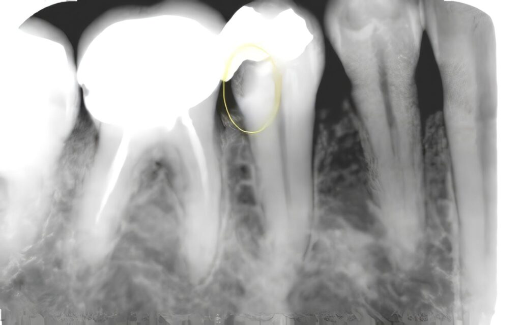 Lesiones Periapicales