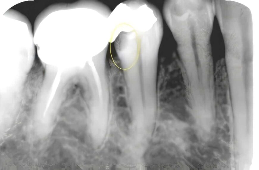 Lesiones Periapicales