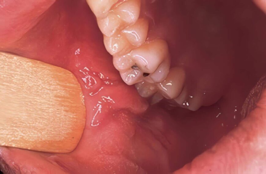 Mucosa Oral