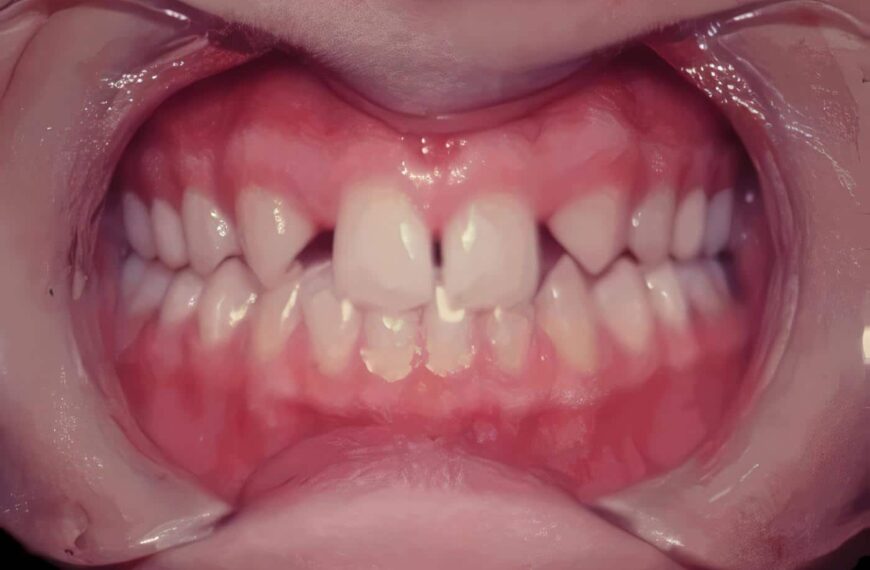 Patogénesis en Enfermedad Periodontal