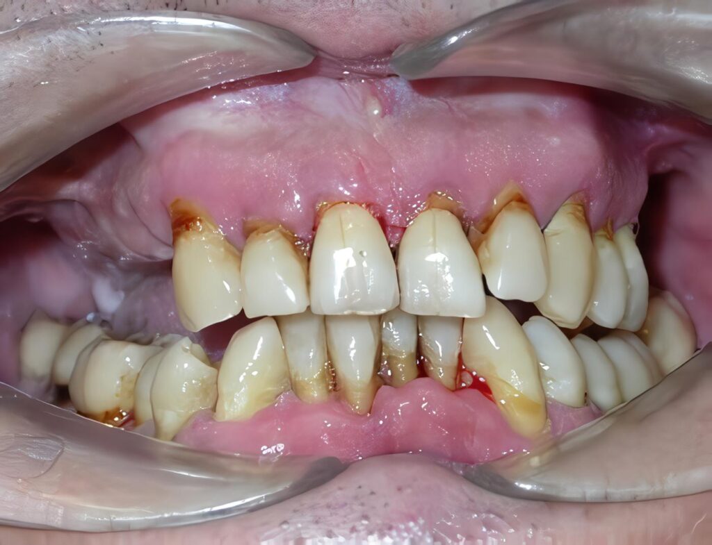 Obtención y Caracterización de una Igy Anti -Porphyromonas Gingivalis