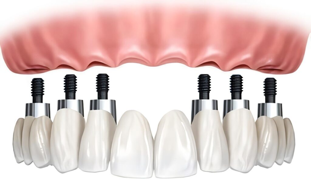 Reimplante Dental Post-Trauma