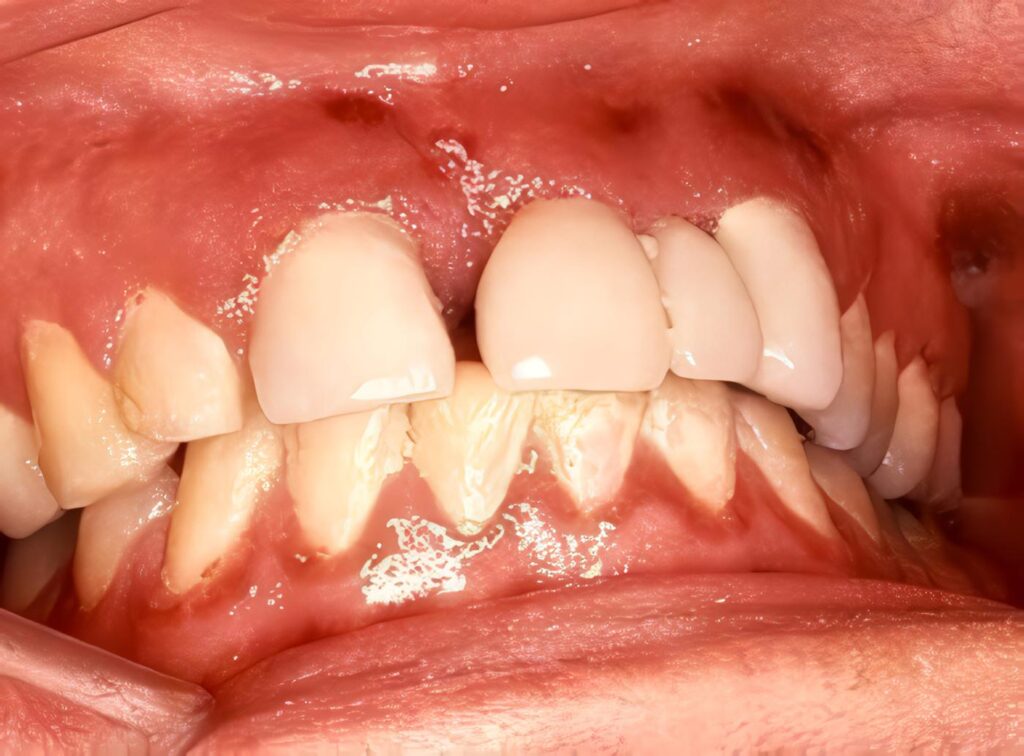 Sarcoma de Kaposi intraoral