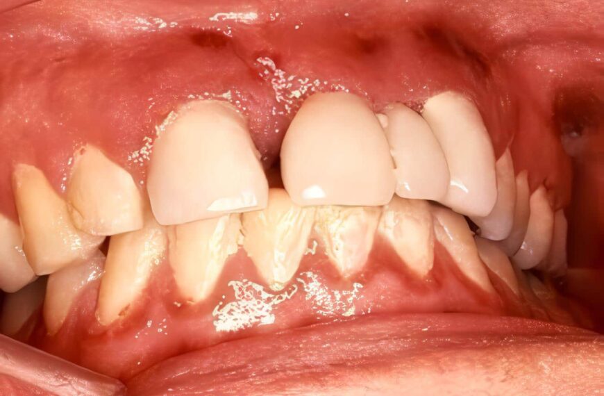 Sarcoma de Kaposi intraoral