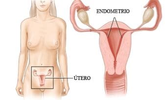 Cáncer de Endometrio