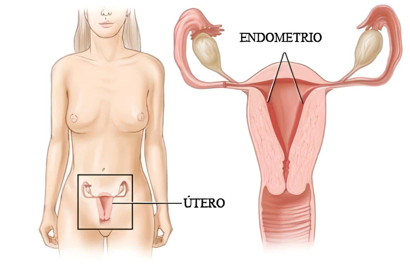 Cáncer de Endometrio