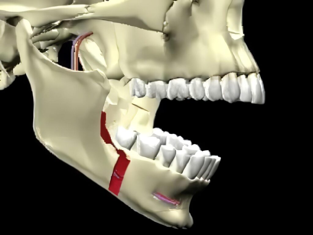 Osteotomía Sagital para Alargamiento del Mentón