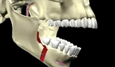 Osteotomía Sagital para Alargamiento del Mentón