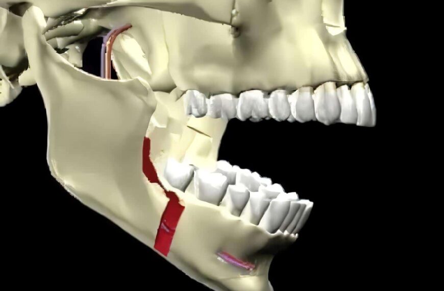 Osteotomía Sagital para Alargamiento del Mentón