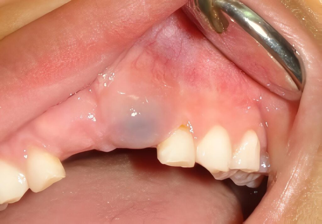 Marsupializacion de Quistes