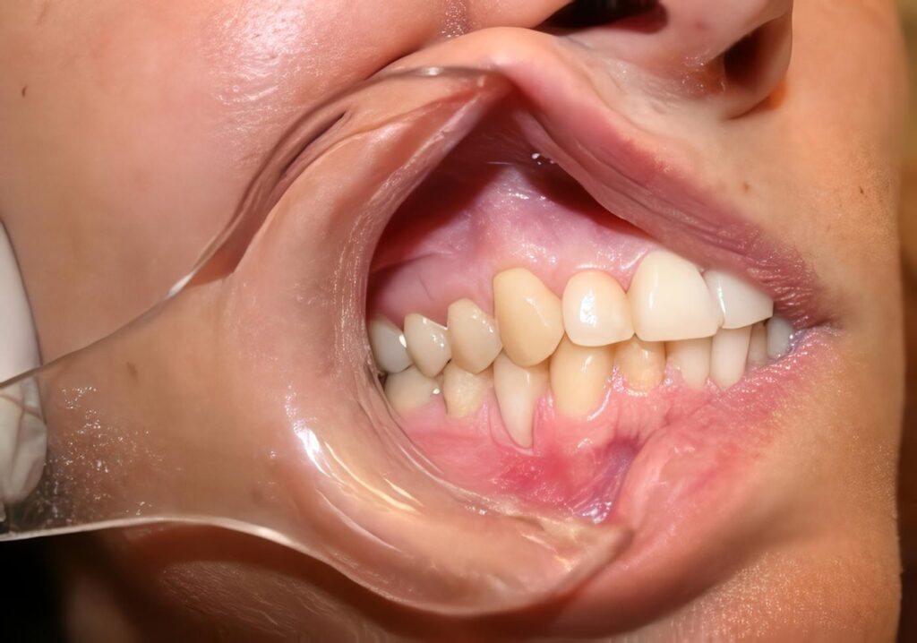 Enfisema Subcutáneo Cervicofacial
