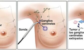 Base de Datos ayuda a evaluar el Riesgo de Cáncer de Mama