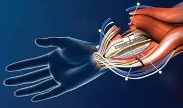 Cerebro se Reprograma después de un Trasplante de Mano