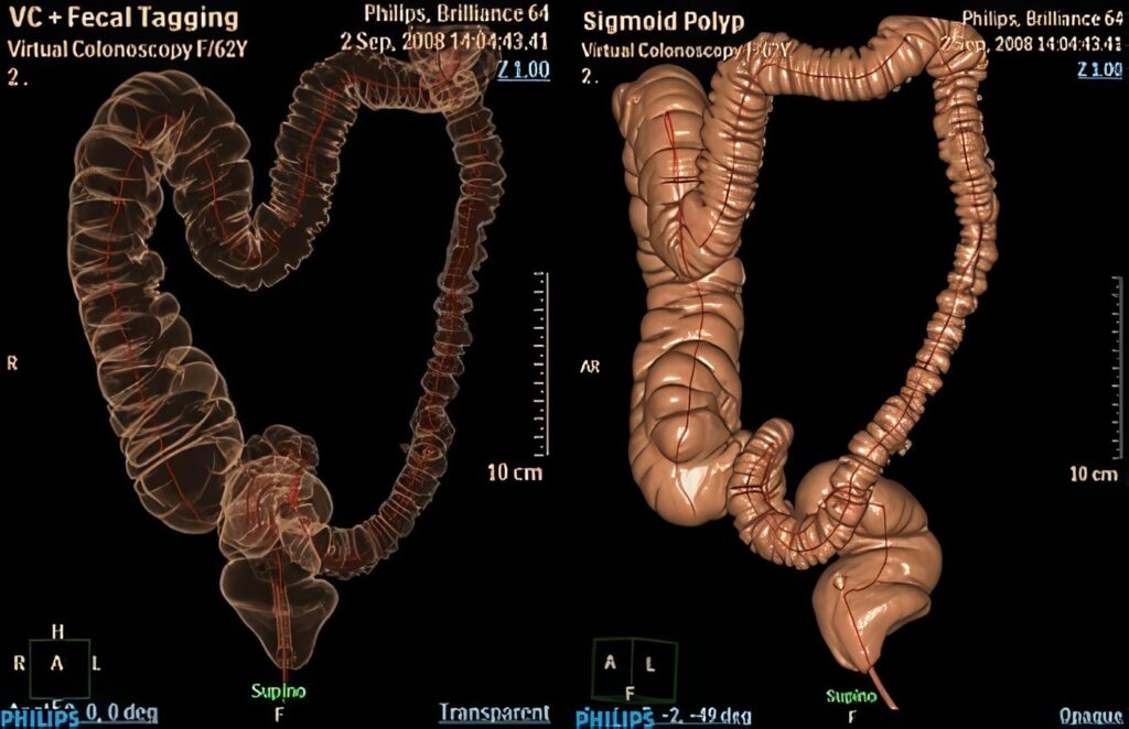 Colonografía por tomografía computarizada