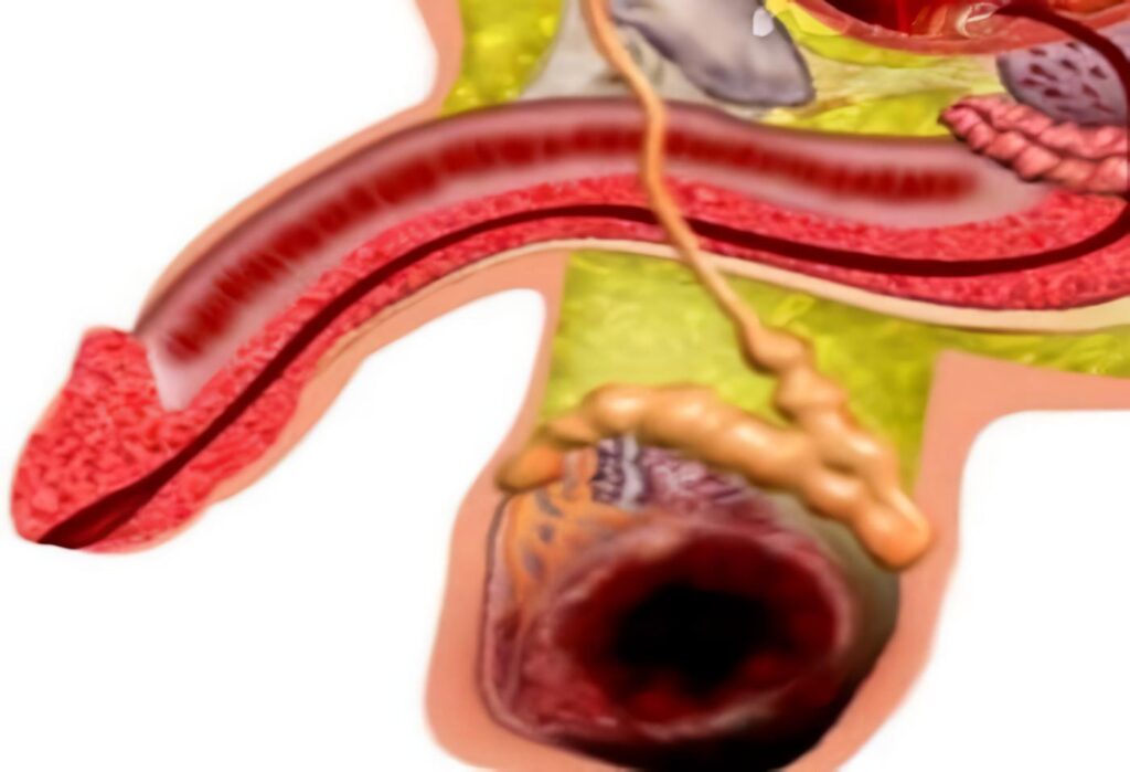 Cáncer Testicular