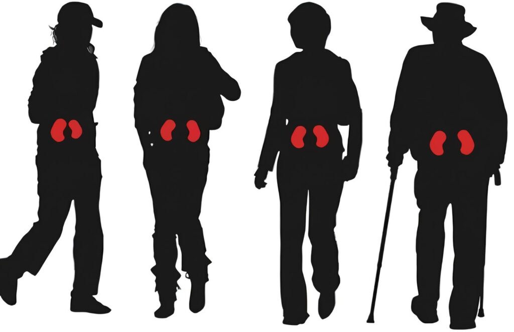 Refrescos y el Cáncer de Páncreas