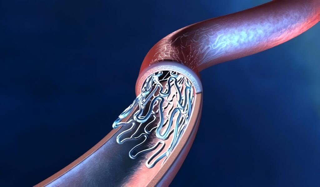Endoprótesis Biodegradable resulta Exitosa en Ensayo con Humanos