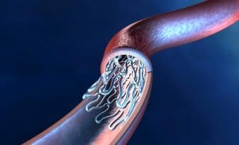 Endoprótesis Biodegradable resulta Exitosa en Ensayo con Humanos