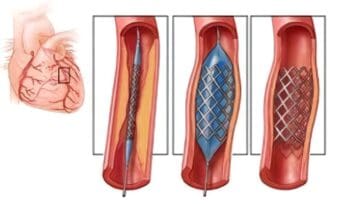 Nuevo Tipo de Endoprótesis Vascular