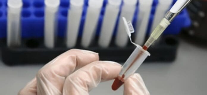 Nuevo Tipo de Fármaco Contra El VIH Frena El Virus