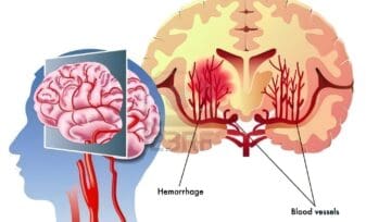 Directrices para la Hemorragia Cerebral