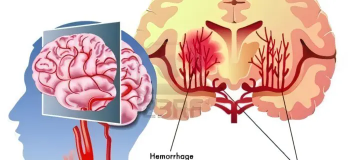 Directrices para la Hemorragia Cerebral