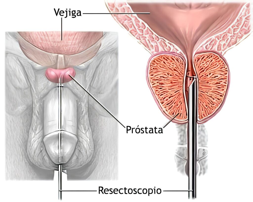 Hormonas sexuales y cáncer de próstata