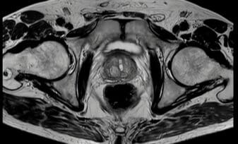 La IRM y La Propagación del Cáncer de Próstata