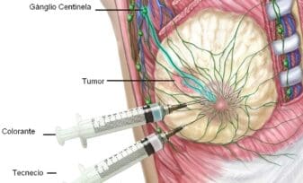 Inyecciones en los Ganglios Linfáticos