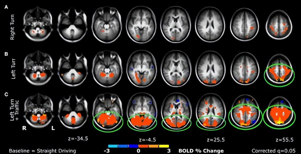 Cierta Lesión de Rodilla estaría ligada a Alteración Cerebral
