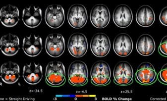 Cierta Lesión de Rodilla estaría ligada a Alteración Cerebral