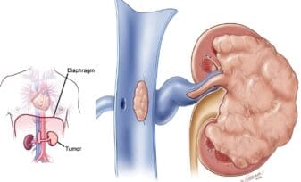 Medicamento Retrasa el Cáncer Renal Avanzado