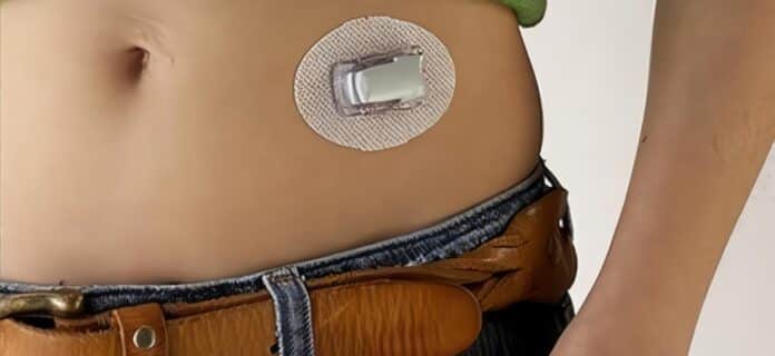 Monitor Subcutáneo de Glucemia mejora el Control de la Diabetes