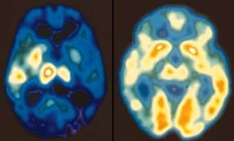 Mutación Genética común reduce el Riesgo de Trastorno Bipolar