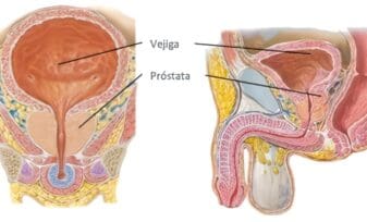 Métodos Quirúrgicos de Próstata