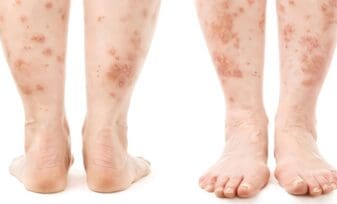 Psoriasis incrementa el Riesgo de Diabetes e Hipertensión