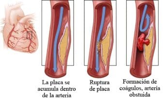 Un Medicamento contra el Cáncer eleva el Riesgo de Coágulos en las Venas