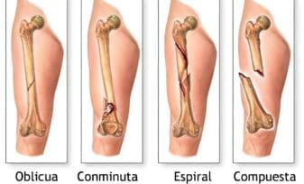 Tamoxifeno Reduce el Riesgo de Fractura, según plantea un estudio