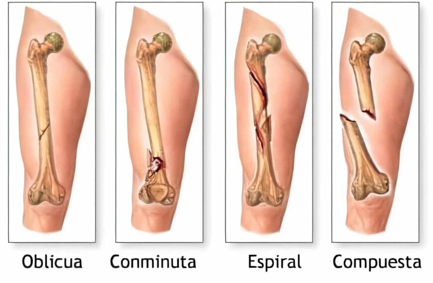 Tamoxifeno Reduce el Riesgo de Fractura, según plantea un estudio