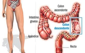cancer de colon en la mujer