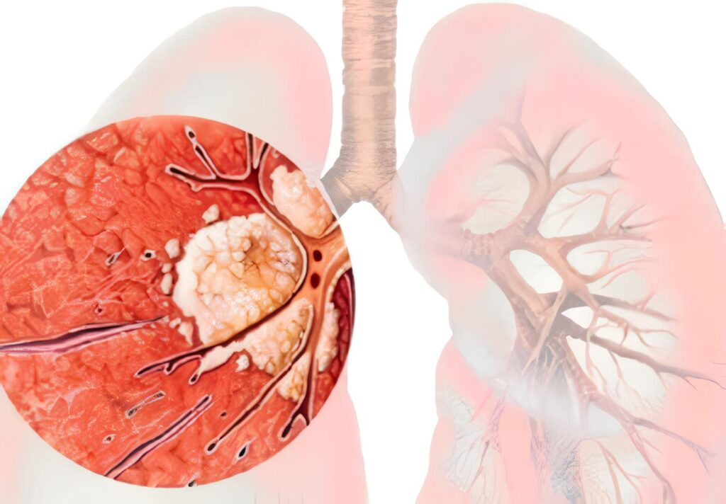 TRH con Cáncer de Pulmón