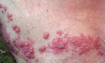 Crema podría Prevenir la Transmisión del Herpes