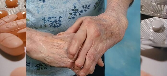 Tratamiento Artritis Reumatoide