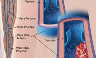 Tromboembolismo Venoso